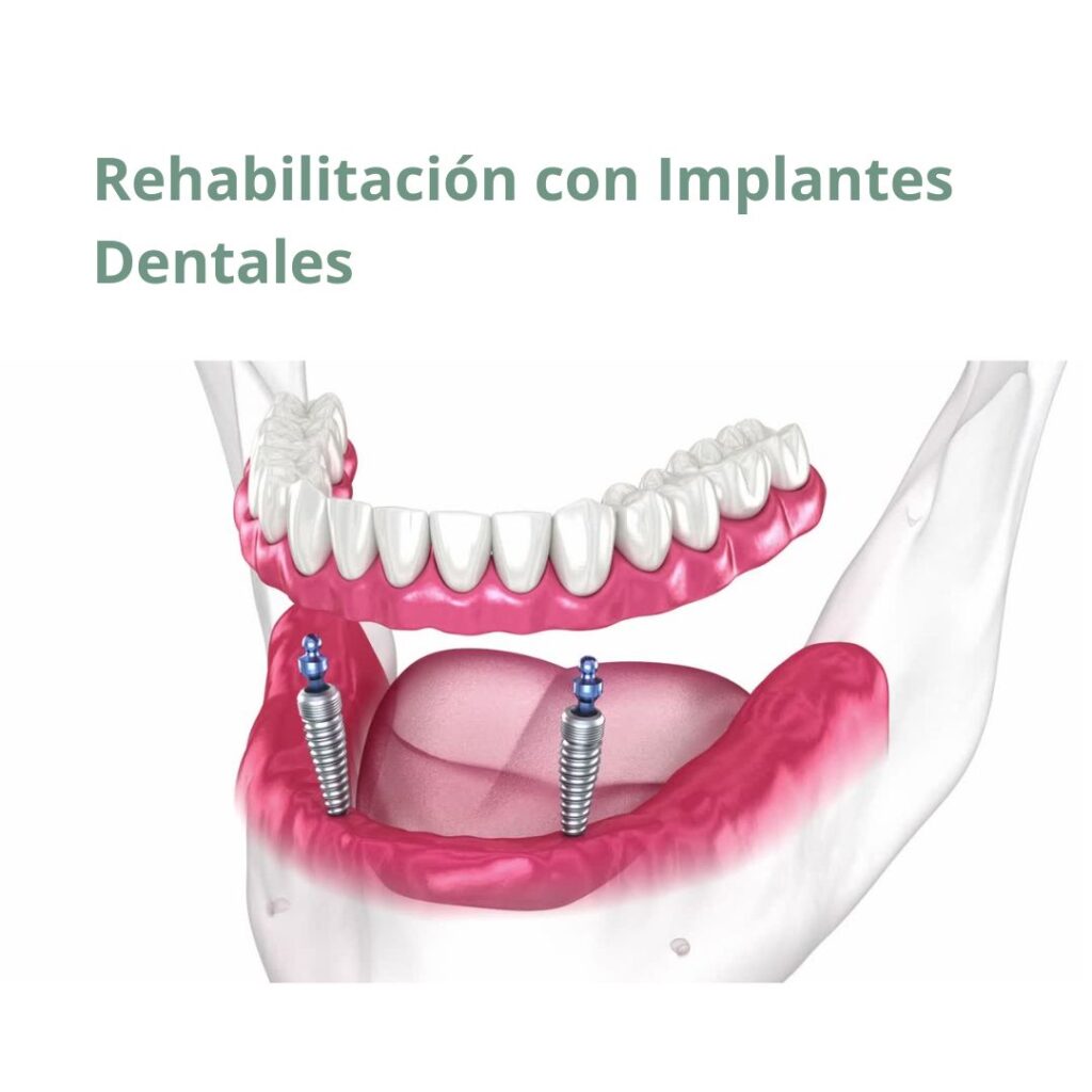 Rehabilitacion con Implantes Dentales en Valladolid